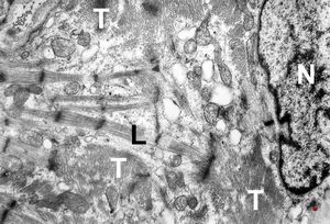 M,47y. | hypertrophic cardiomyopathy - left ventricle ( N - nucleus, T- transversally oriented, L- longitudinally oriented myofibrils ) M,47y. | hypertrophic cardiomyopathy - left ventricle ( N - nucleus, T- transversally oriented, L- longitudinally oriented myofibrils )